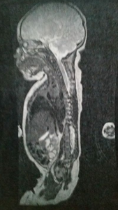 MRI view of infant with sacral agenesis