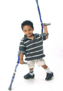 boy with sacral agenesis / caudal regression walking front page